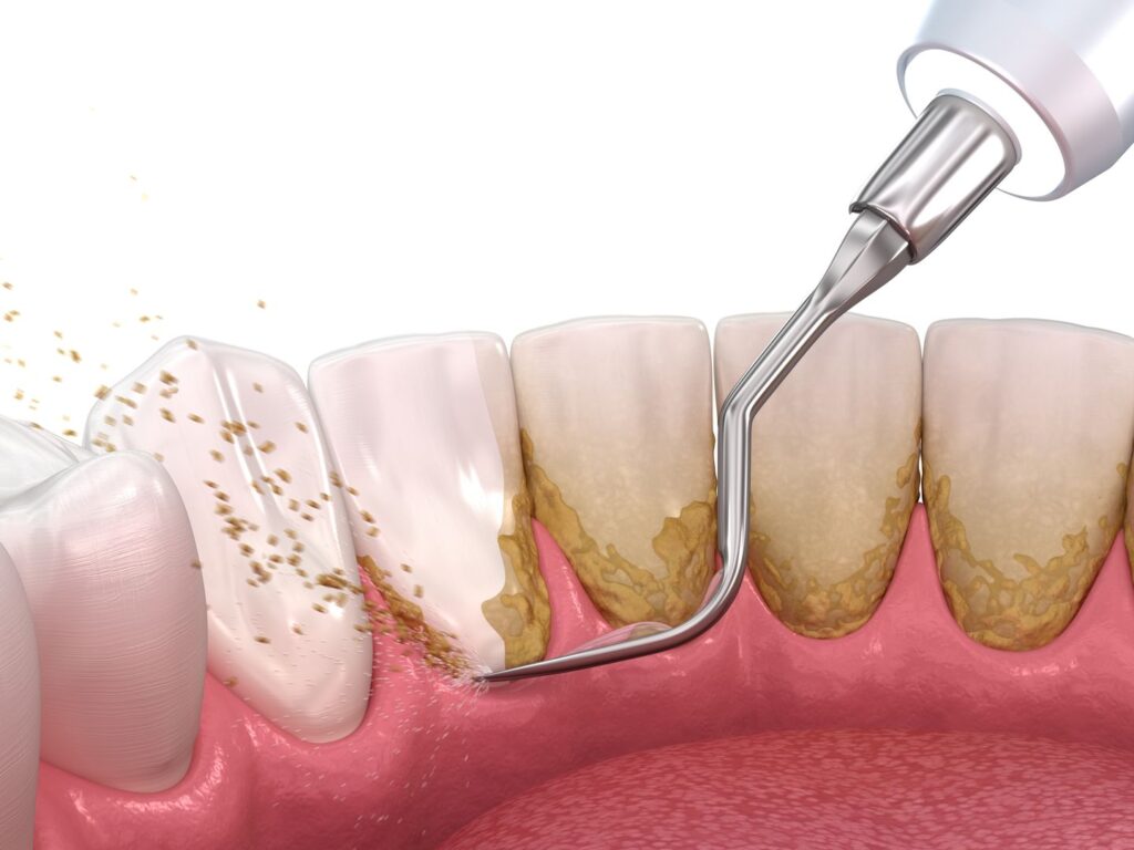 Dental Scaling