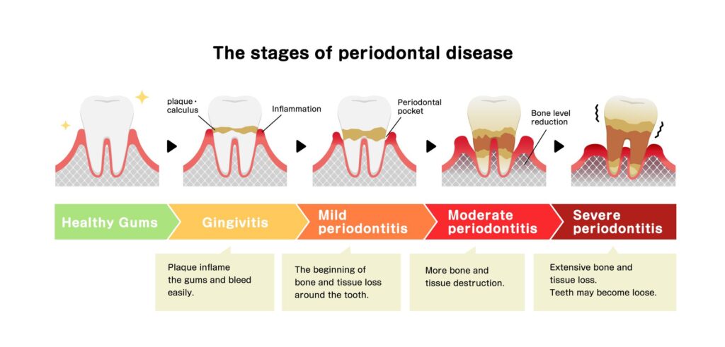 Periodontal Disease