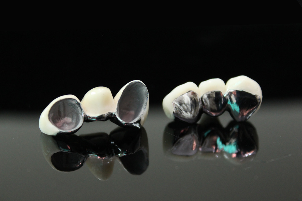 Porcelain Fused To Metal Crowns