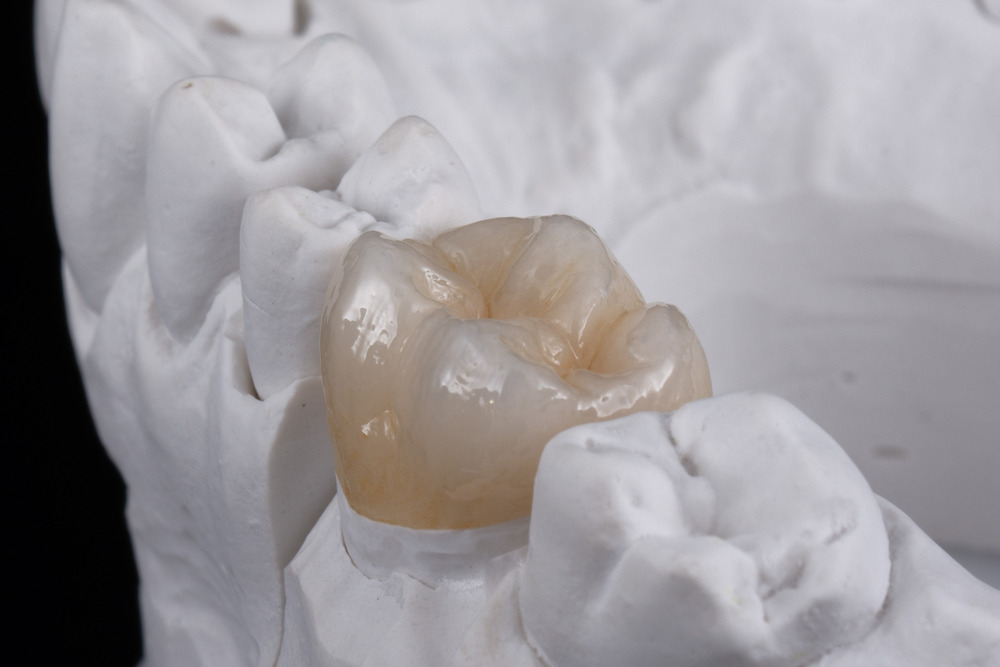 Zirconia Crowns