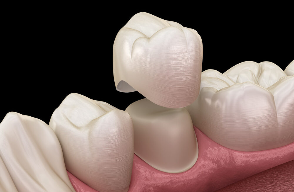 Dental Crown