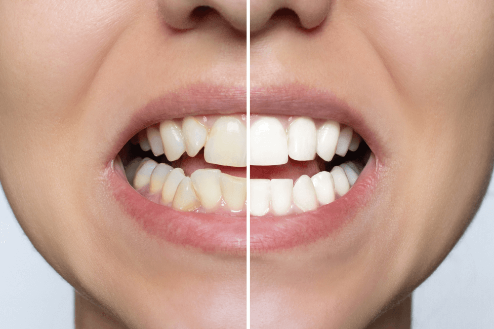 Advantages of Composite Veneers