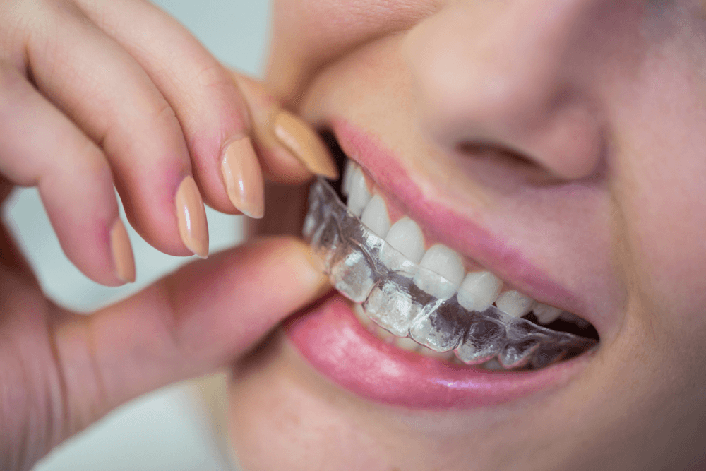 Benefits of Instant Orthodontics (Veneers) vs. Braces