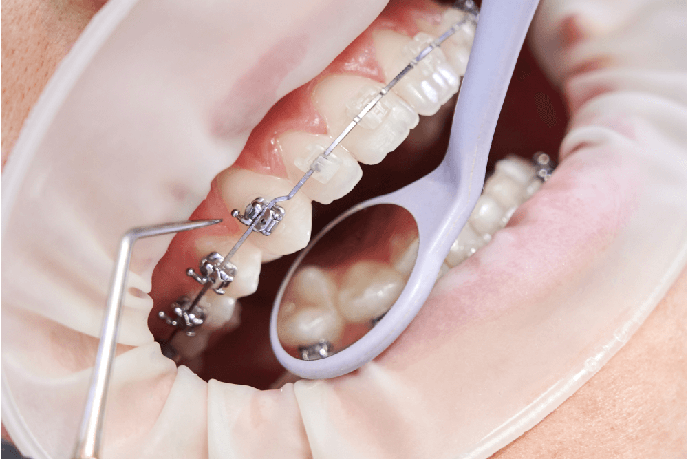 What Is Instant Orthodontics